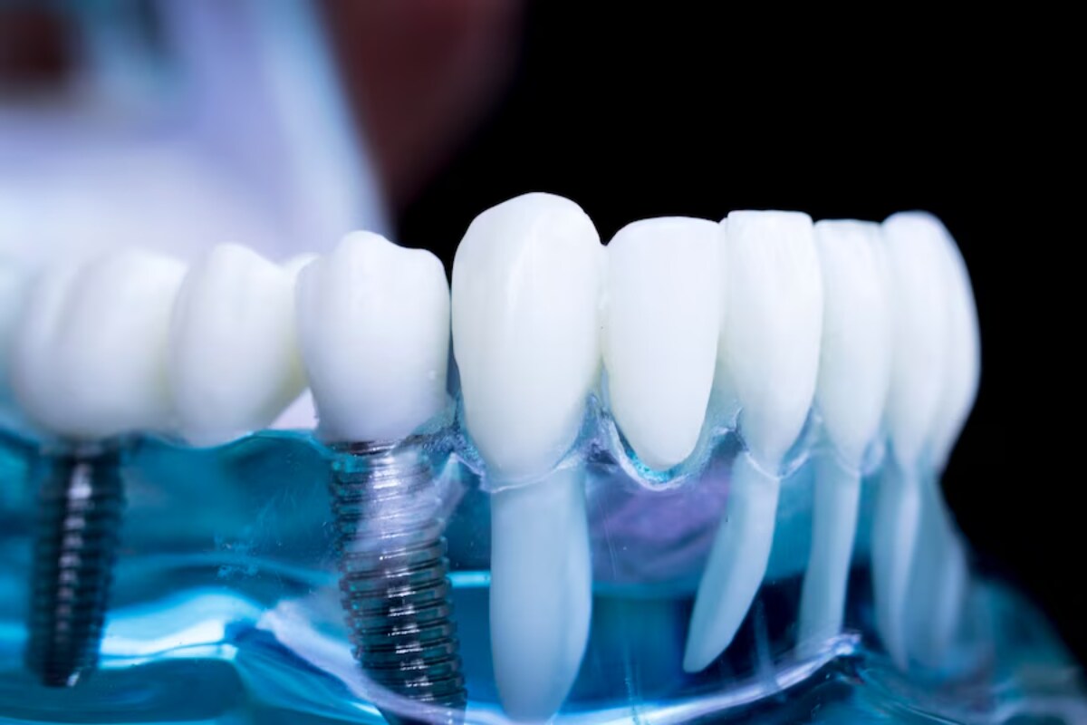 durability of dental crowns