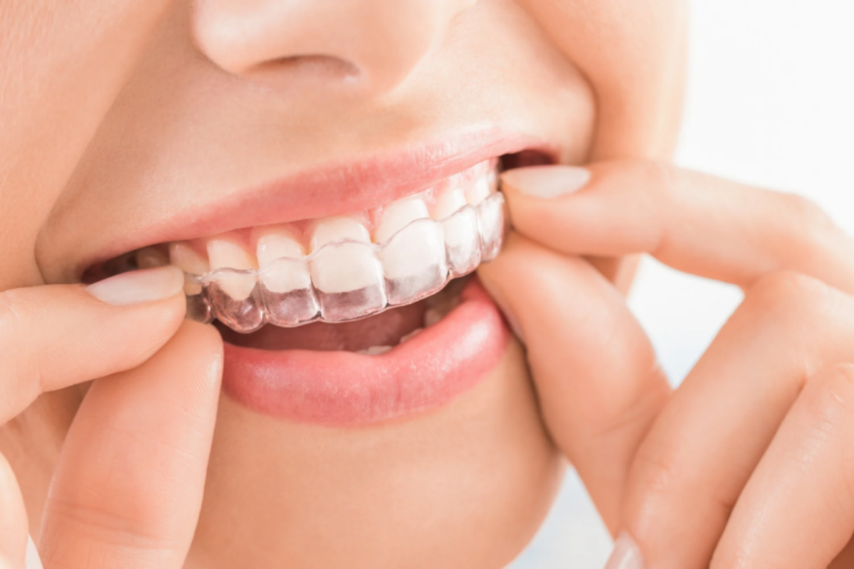 invisalign vs. traditional braces: which is right for you.